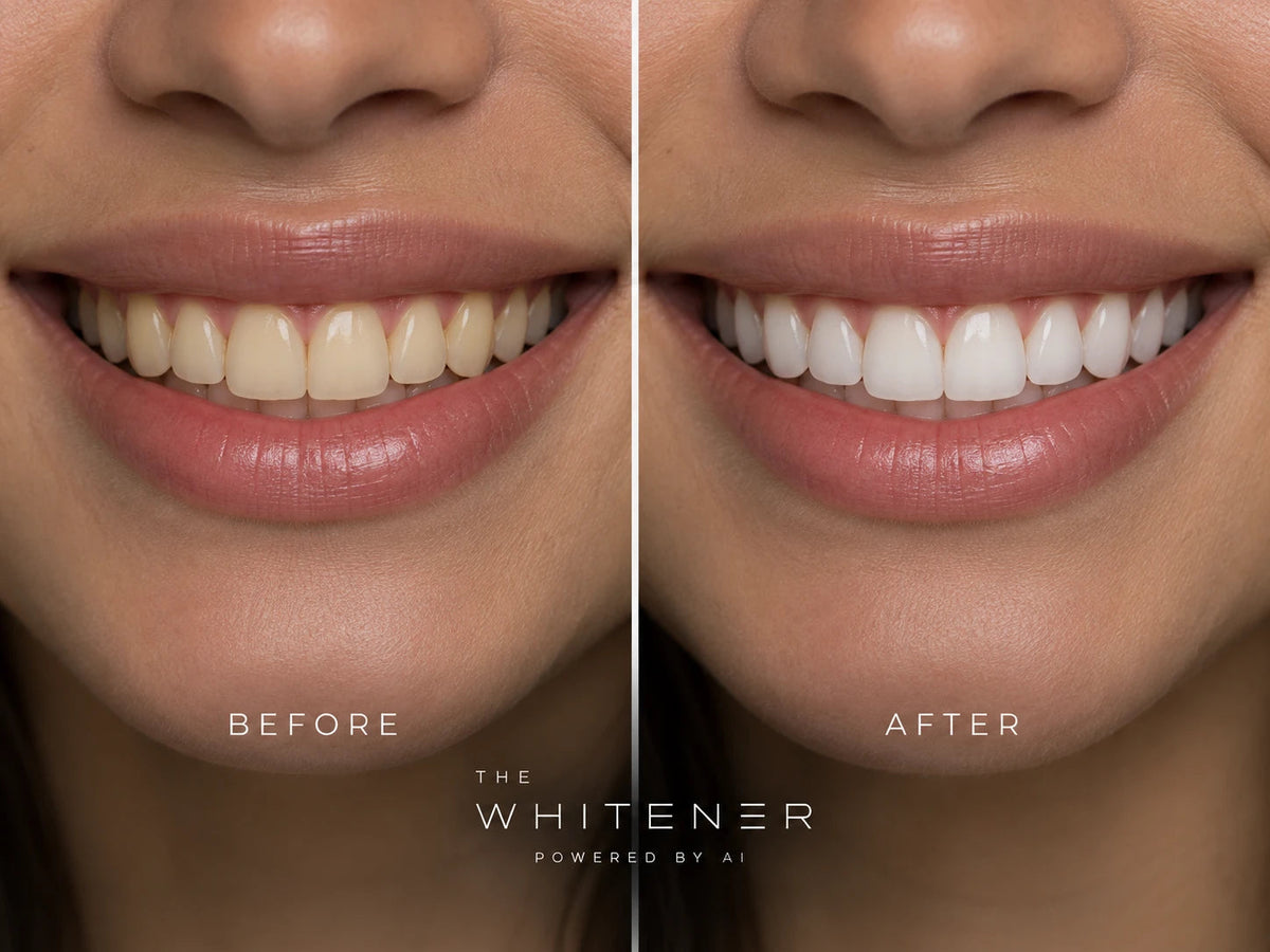 Comparaison avant / après blanchiment avec The Whitener